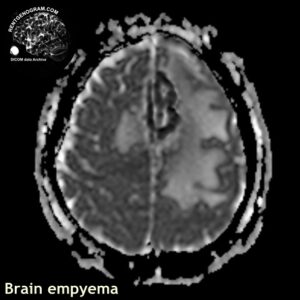 empyema_head MRI_5