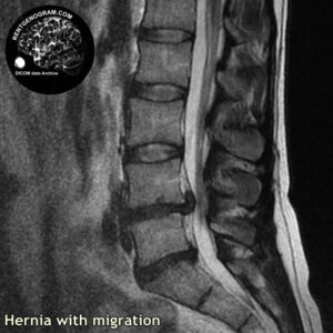 migratio_hernia_l-spine_MRI_5