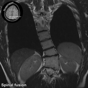 Spinal fusion_MRI_5