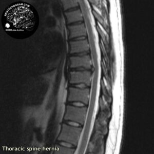 hernia_th-spine_MRI_1