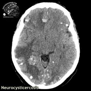 neurocysticercosis_head CT_4