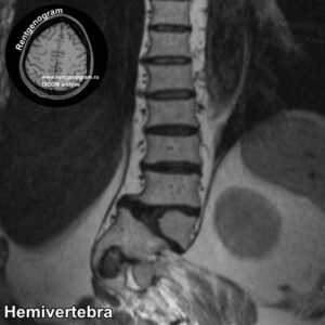 Hemivertebra_MRI_2