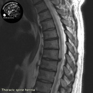 hernia_th-spine_MRI_2