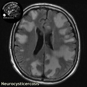neurocysticercosis_head MRI_1