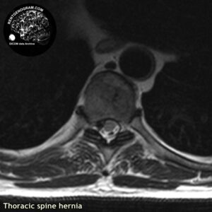 hernia_th-spine_MRI_3