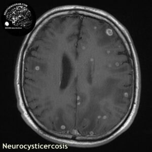 neurocysticercosis_head MRI_2