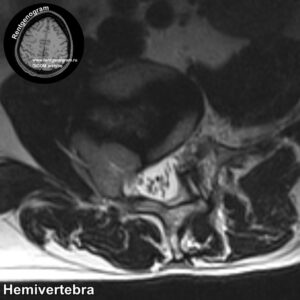 Hemivertebra_MRI_4