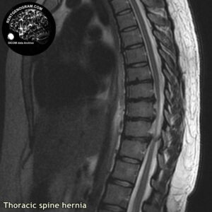 hernia_th-spine_MRI_4