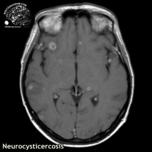 neurocysticercosis_head MRI_3