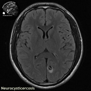 neurocysticercosis_head MRI_5