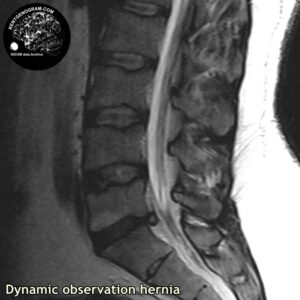 dynamic_hernia_l-spine_MRI_1