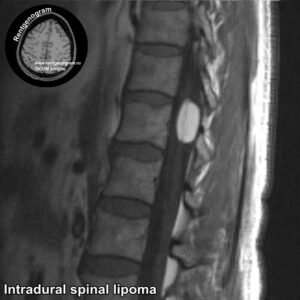 Intradural spinal lipoma_MRI_1