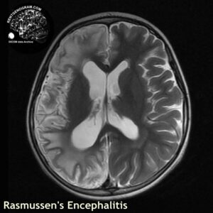 rasmussen_head MRI_1