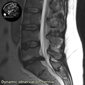 dynamic_hernia_l-spine_MRI_2
