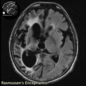 rasmussen_head MRI_2
