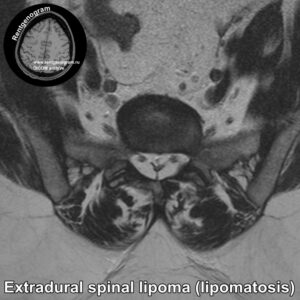 Extradural spinal lipoma_MRI_3