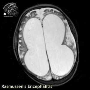 rasmussen_head MRI_3