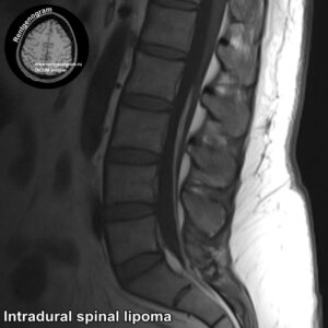 Intradural spinal lipoma_MRI_4