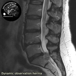 dynamic_hernia_l-spine_MRI_5
