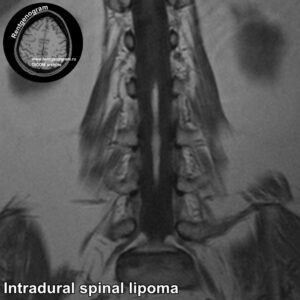 Intradural spinal lipoma_MRI_5