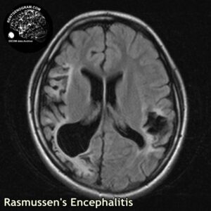 rasmussen_head MRI_5