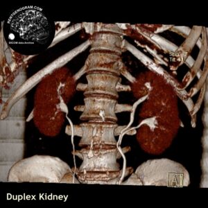 kidney_duplication_ct_3d