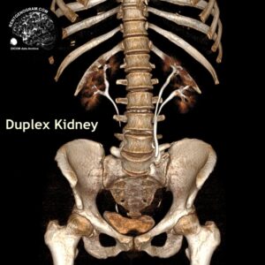 kidney_duplication_ct_ssd