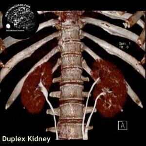 kidney_duplication_ct_ssd_3d