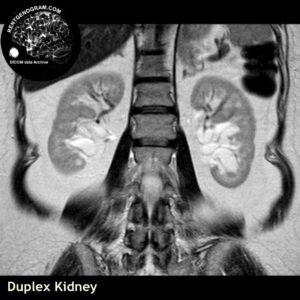kidney_duplication_mri_t2_cor
