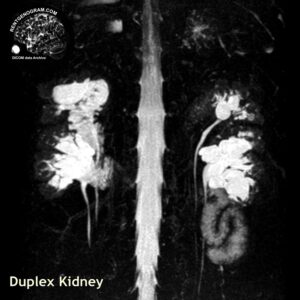kidney_duplication_mri_urography_cor