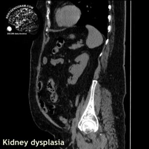 kidney_dysplasia_ct_sag