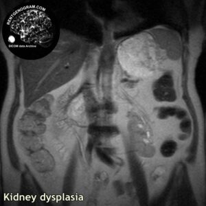 kidney_dysplasia_mri_t2_cor