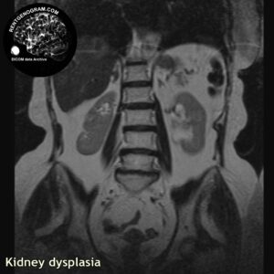 kidney_dysplasia_mri_t2_cor_256