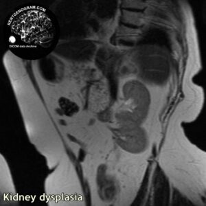 kidney_dysplasia_mri_t2_sag
