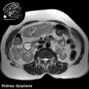 kidney_dysplasia_mri_t2_tra