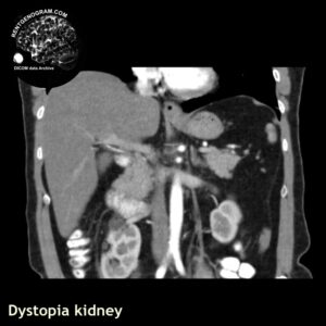 kidney_dystopia_ct_gd_cor
