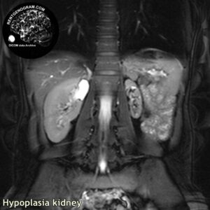 kidney_hypoplasia_mri_stir_cor