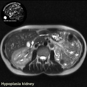 kidney_hypoplasia_mri_t2_ax