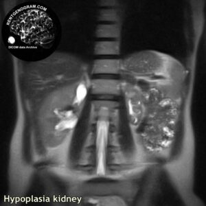 kidney_hypoplasia_mri_t2_cor
