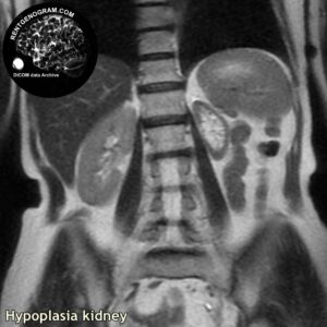 kidney_hypoplasia_mri_t2_cor_512
