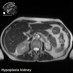 kidney_hypoplasia_mri_t2_tra