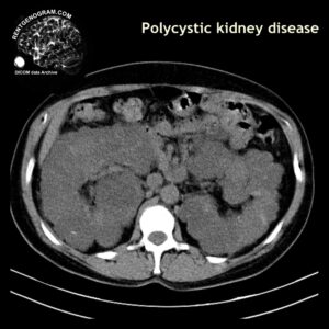 kidney_policystosis_ct_tra