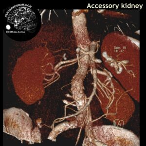 other_anomaly_accessory_kidney_ct_bolus_ssd