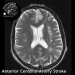 head MRI stroke ACA 0,3Т