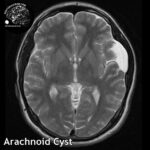 1.2 arachnoid_cysts_head_MRI_2