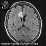 head MRI stroke ACA 0,25T