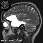1.3 arachnoid_cysts_head_MRI_3