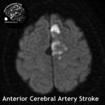 head MRI stroke ACA