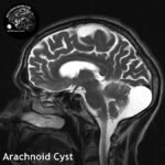 1.4 arachnoid_cysts_head_MRI_4