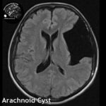 1.5 arachnoid_cysts_head_MRI_5